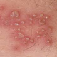 Illustration for article titled obat herpes zoster
